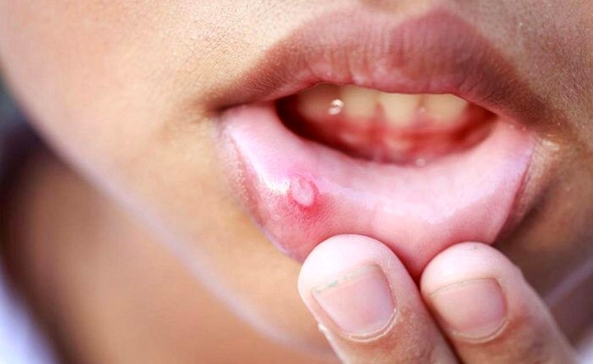 نابودی آفت دهان با ترکیب قره‌قروت و یک ماده جادویی! + انواع روش درمان