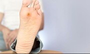 علائم این بیماری خطرناک که روی پاها خود را نشان می‌دهد!