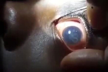 بیماری وحشتناک کرم چشم در آفریقا! + فیلم