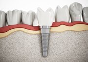 ۷ گام اصلی از مراحل ایمپلنت دندان چیست؟