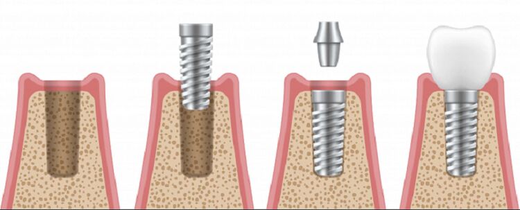 7 گام اصلی از مراحل ایمپلنت دندان چیست؟