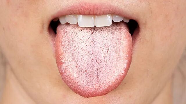 The cause of white tongue