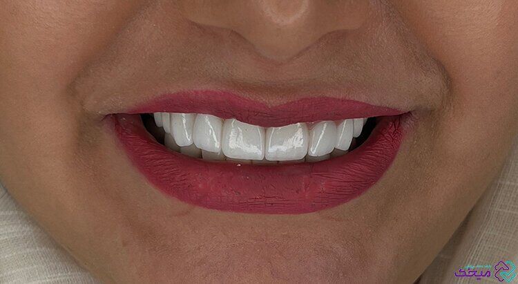 لمینت دندان چقدر به دندان آسیب می رساند؟