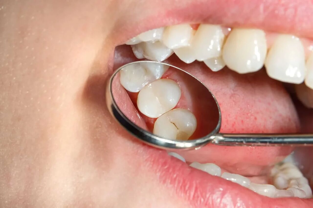 ریشه این ۳ بیماری مرگبار پوسیدگی دندان است