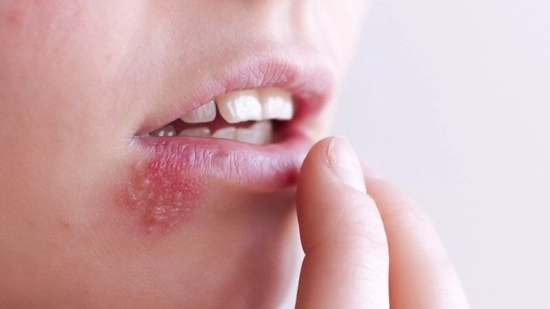 چرا تبخال می زنیم و چطور باید از شر آن خلاص شویم؟