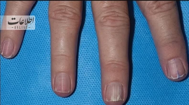 ناخنهای عجیب و غریب نشانه این سرطانهاست! + تصاویر