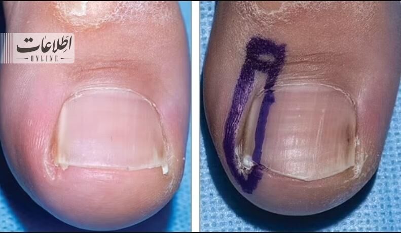 ناخنهای عجیب و غریب نشانه این سرطانهاست! + تصاویر