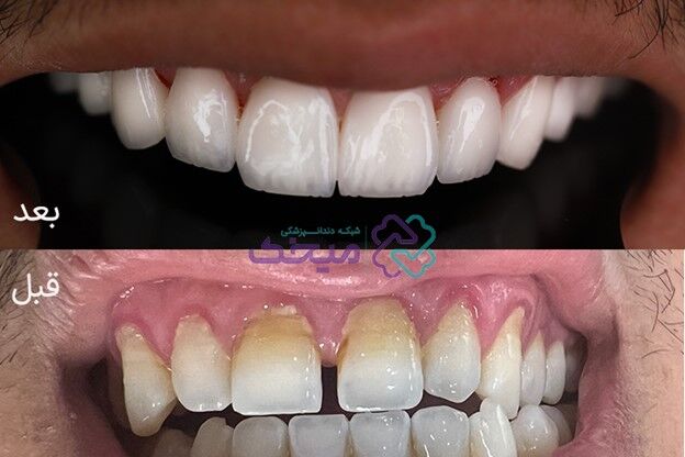 انجام لمینت دندان از دَم قسط؛ بدون ضامن و بدون پیش پرداخت