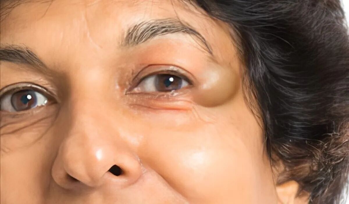 آیا کیست چشم خطرناک است؟1