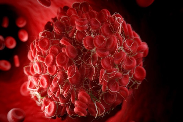 عوامل اکتسابی و ارثی ایجاد لخته‌های وریدی خون