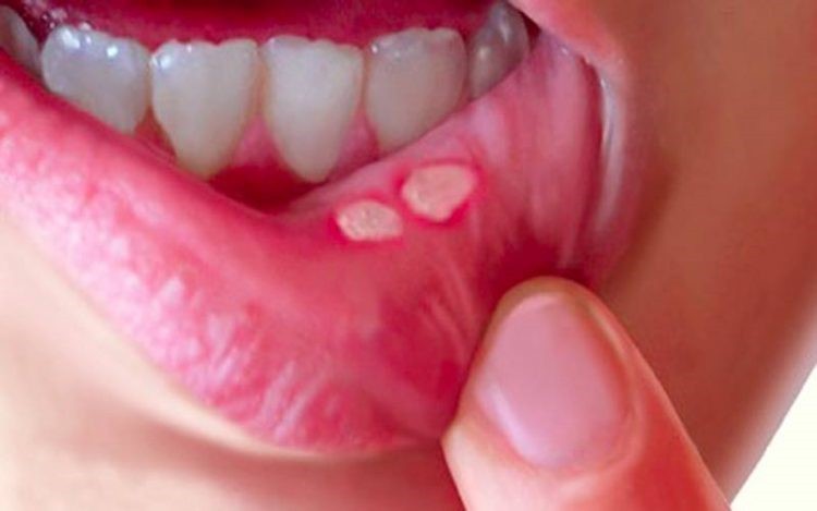 محلول گیاهی برای درمان زخم های دهان + عکس