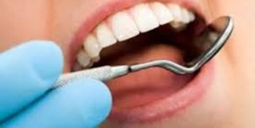 نکاتی که باید درباره سفید کردن دندان بدانید
