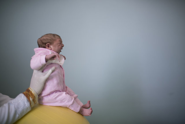 احتمال بروز میکروسفالی در نوزادان آلوده به زیکا چند ماه پس از تولد