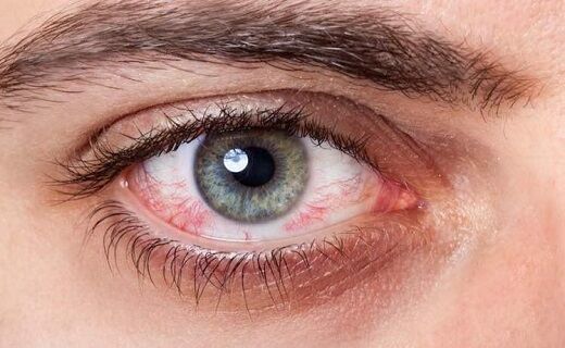 قرمز شدن چشم ها؛ از علت تا درمان + عکس