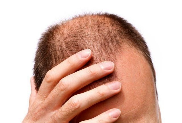 مردانی که دچار ریزش مو هستند، بخوانند