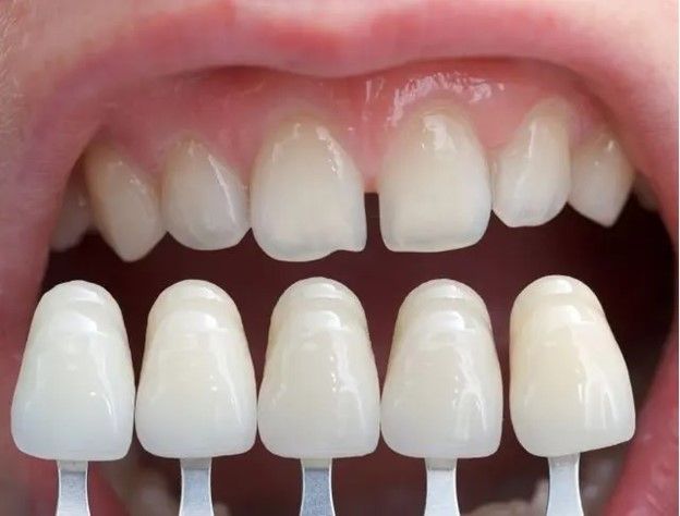 اگر برای لمینت یا کامپوزیت دندان هایتان تردید دارید، بخوانید