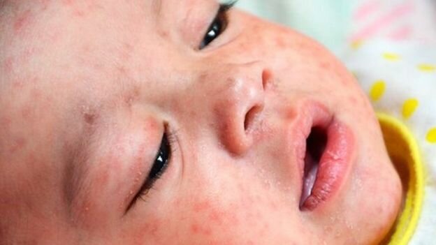 تاکید بر لزوم تزریق واکسن سرخک به کودکان
