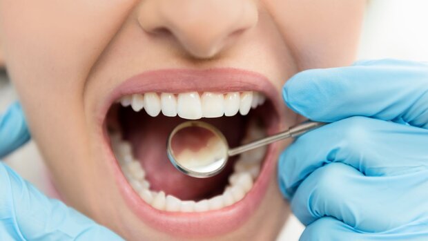 عمر مفید ایمپلنت‌های دندانی ۱۰سال است