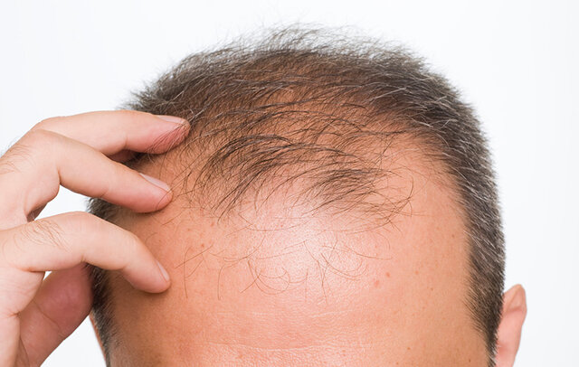 ۷راه مؤثر در کاهش ریزش مو