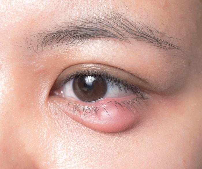 علت احساس درد در چشم ها چیست؟