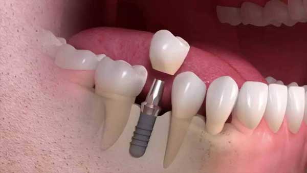 عوارض جبران ناپذیر جای خالی حتی یک دندان در دهان