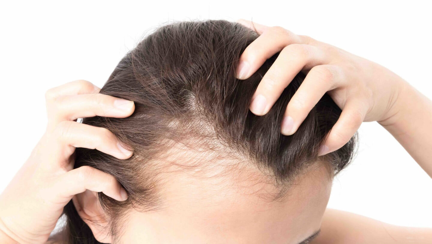 یک درمان جدید برای ریزش مو