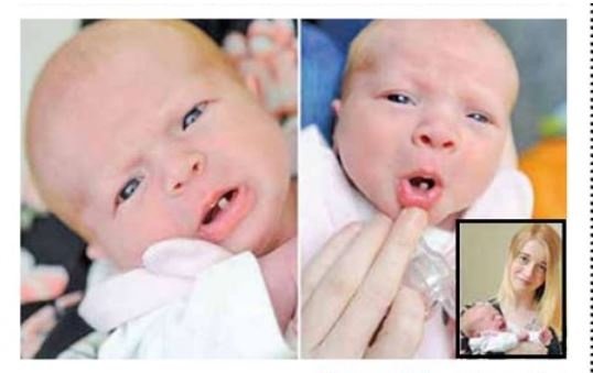 دختری که با یک دندان به دنیا آمد  +عکس