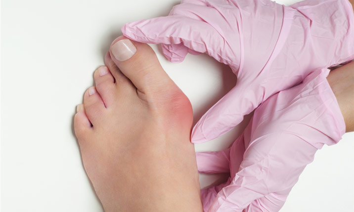 راه های طبیعی برای تسکین درد انحراف شست پا