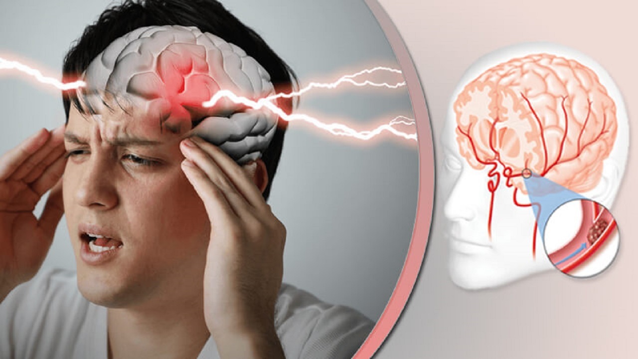 پیش بینی خطر سکته مغزی با اندازه و شکل عروق خونی مغز