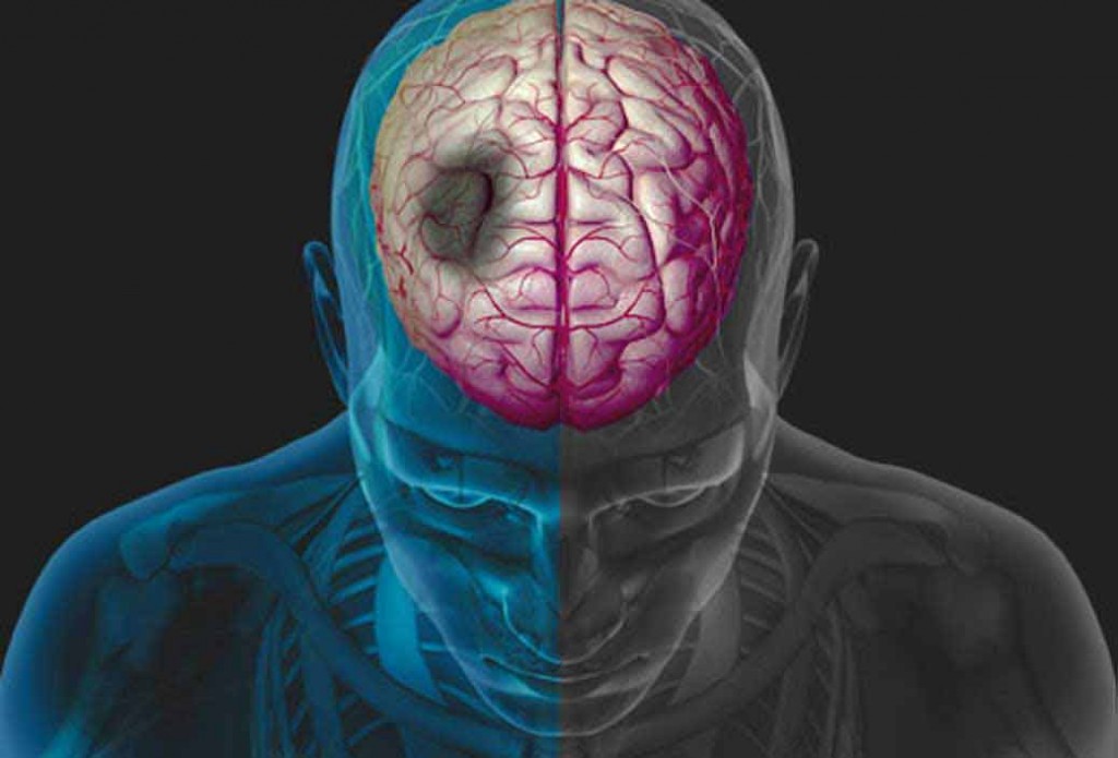 نشانه های سکته مغزی ناقص چیست؟