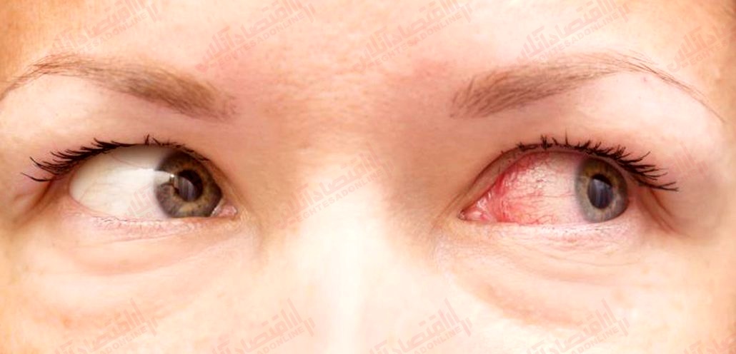 بیماری چشم صورتی چه مدت طول می‌ کشد؟ 