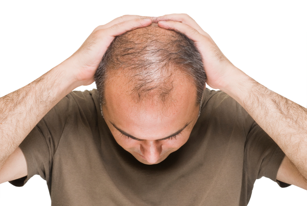 ۲۰ دلیل اصلی ریزش مو و راه های درمان

