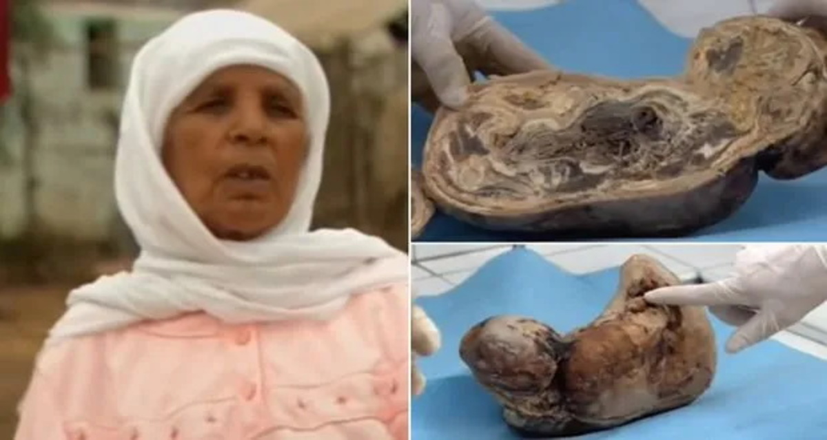 زنی بعد از ۴۵ سال یک نوزاد سنگی به دنیا آورد! + عکس