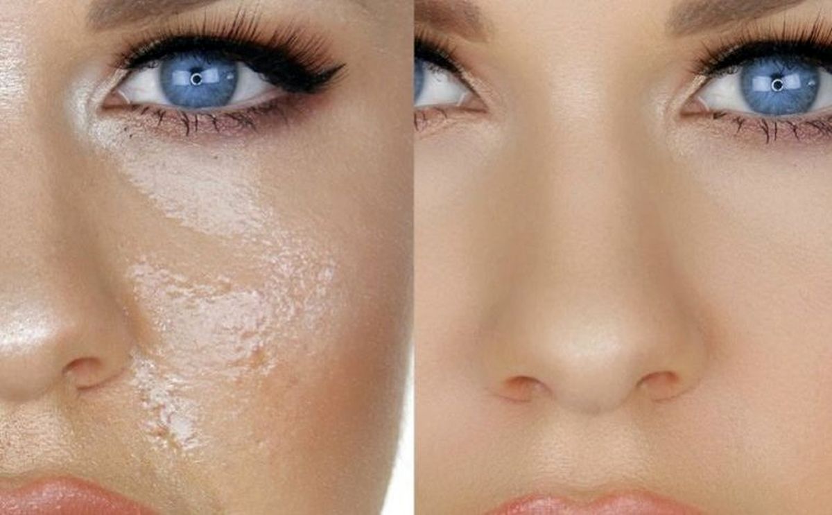 اسرار زیبایی؛ چطور چربی پوست را کاهش دهیم؟