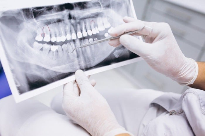 تریسموس دندانی چیست؟