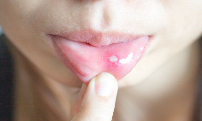 7درمان خانگی برای زخم‌های دهان