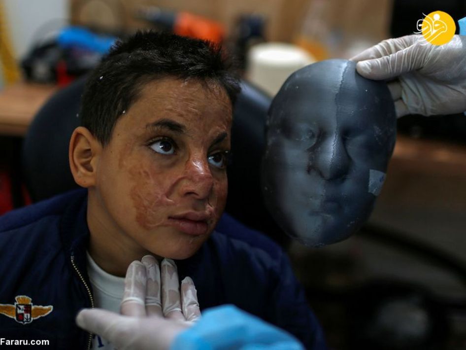  ماسک سه بعدی برای قربانیان سوختگی صورت +عکس
