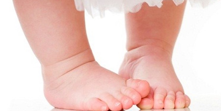 «پای پرانتزی» نوزادان در چه سنی قابل تشخیص است؟