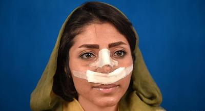 چرایی گسترش جراحی‌های زیبایی بین زنان ایرانی