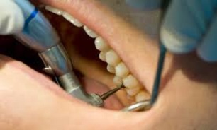 استفاده نابجا از کامپوزیت باعث تخریب دندان می‌شود