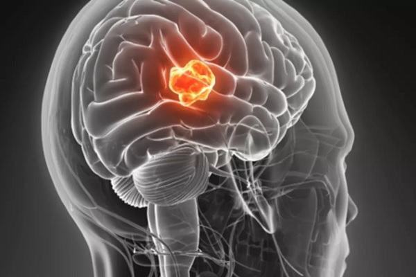 ۵ راهکار ساده برای کنترل و درمان تومورهای مغزی لاعلاج