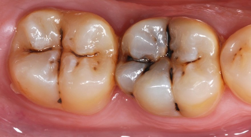مخدرهای سنتی و صنعتی بر دندان‌ها چه تاثیری دارد؟