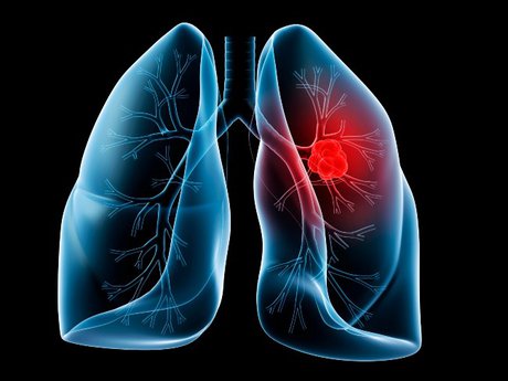 یافته های جدید و زودبازده در درمان سرطان ریه