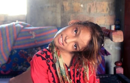 اختلال عجیب دختر ۱۱ساله پاکستانی +عکس
