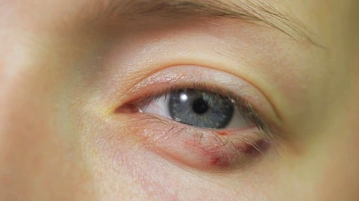 درمان کبودی دور چشم با روش های خانگی