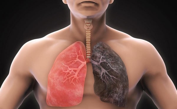 این ۵ نشانه زنگ خطر ابتلا به سرطان ریه است!