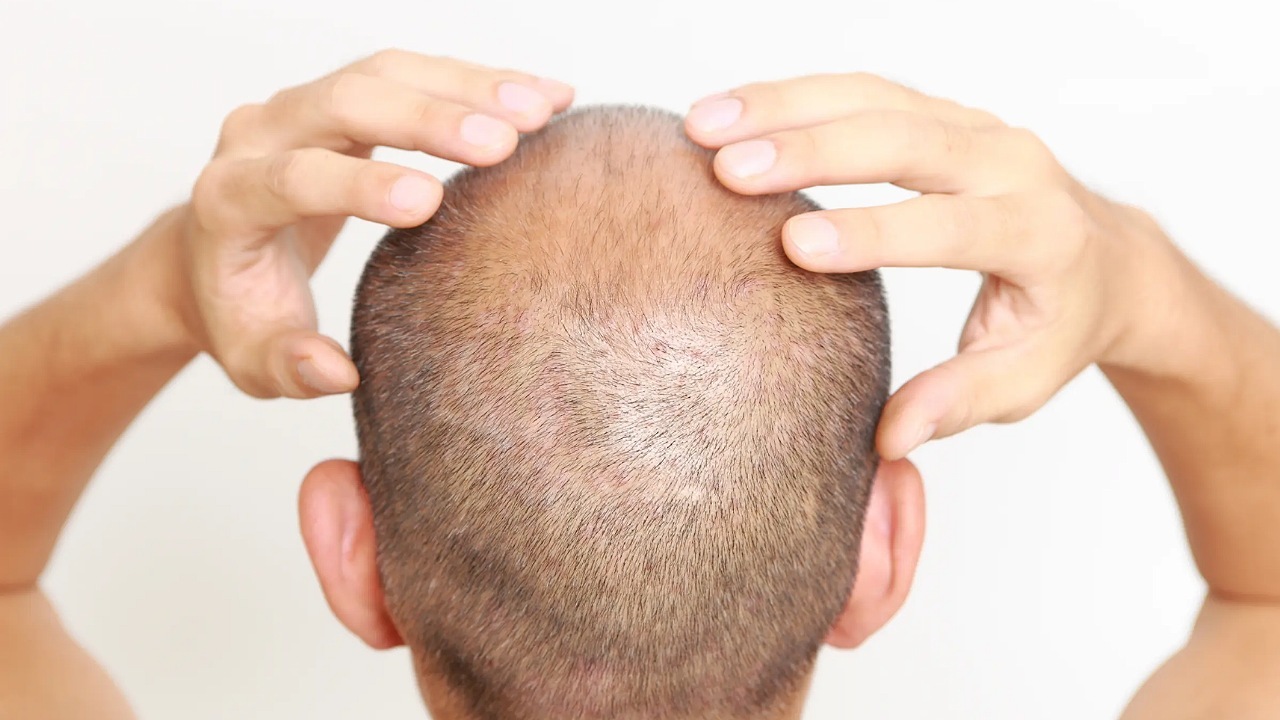 مولکول رشد مجدد مو در افراد طاس کشف شد