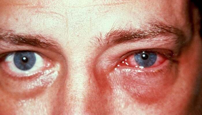 هشت عفونت شایع چشم و نحوه درمان آن‌ ها