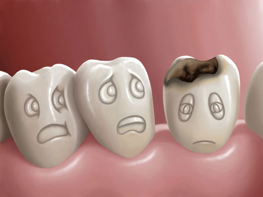 راه‌هایی برای پیشگیری از پوسیدگی دندان