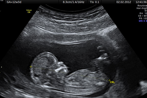بهترین زمان انجام سونوگرافی تعیین جنسیت کدام ماه بارداری؟